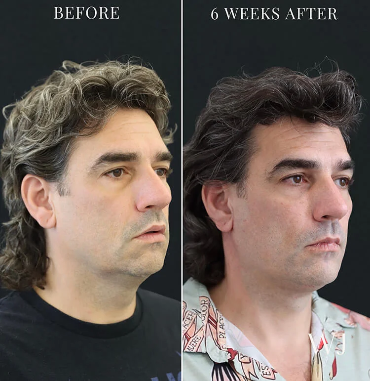 Bernie before and after