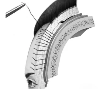 Gliding browlift