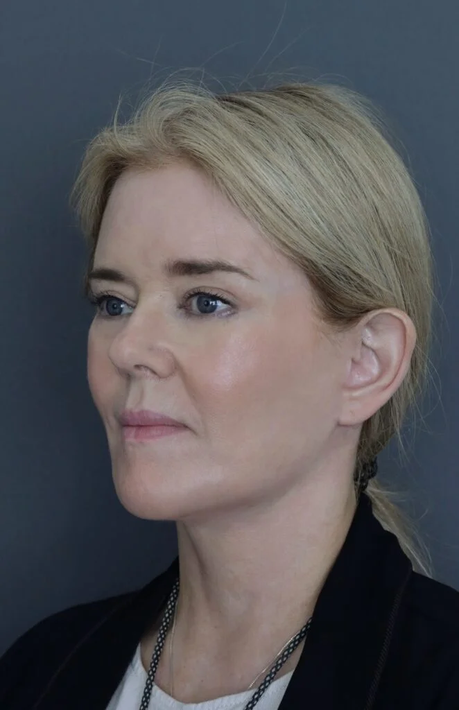 Channel 4 Joyce 9 months post hybrid endoscopic facelift
