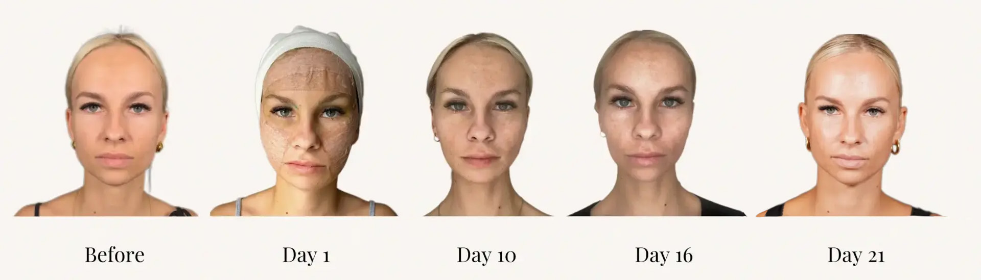 S-PONYTAIL-FACELIFT-RECOVERY-1