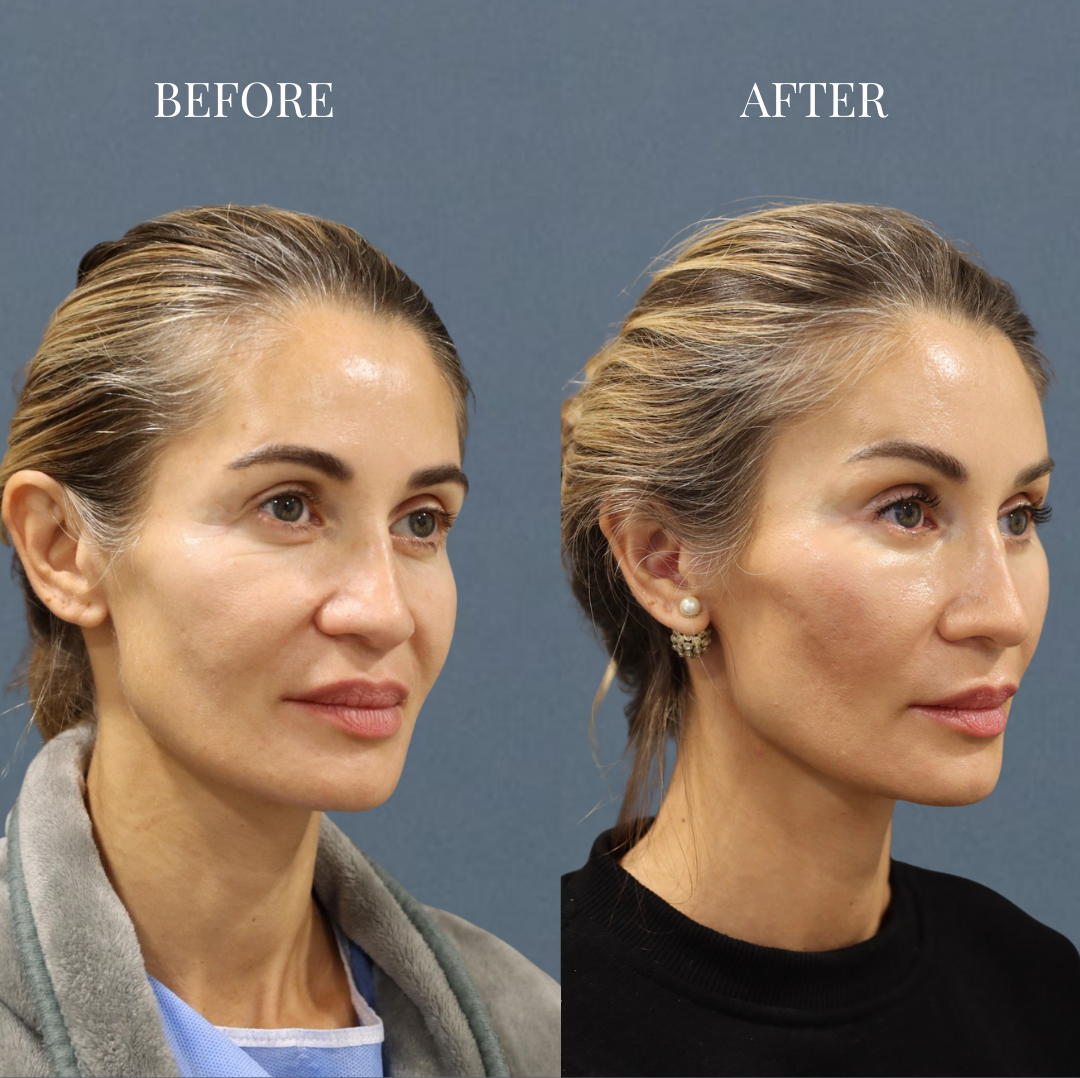 Endoscopic Facelift B&A